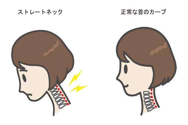 ストレートネックと正常な首のカーブの違いを横から比較した女性のイラスト