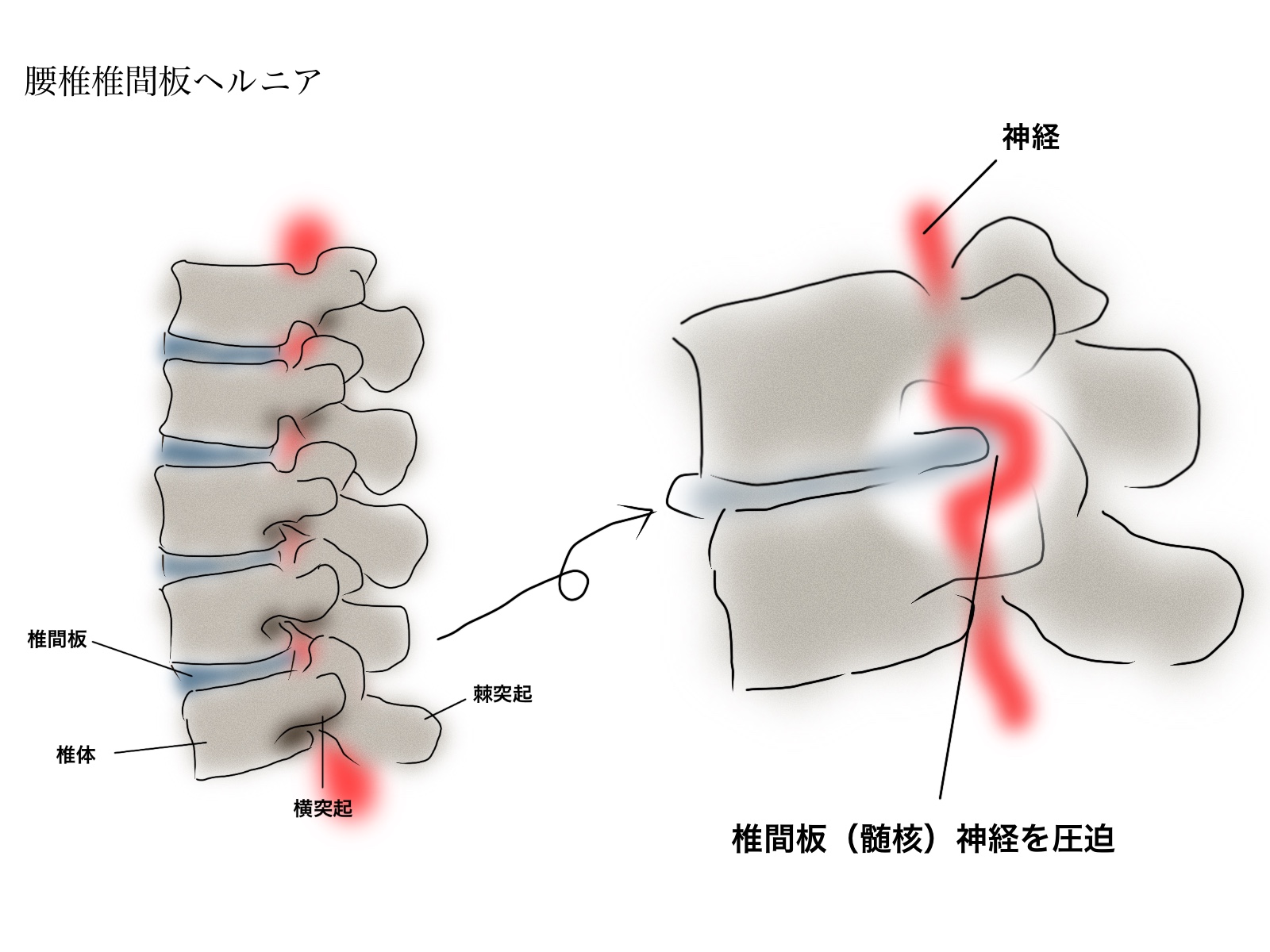 腰椎椎間板ヘルニア