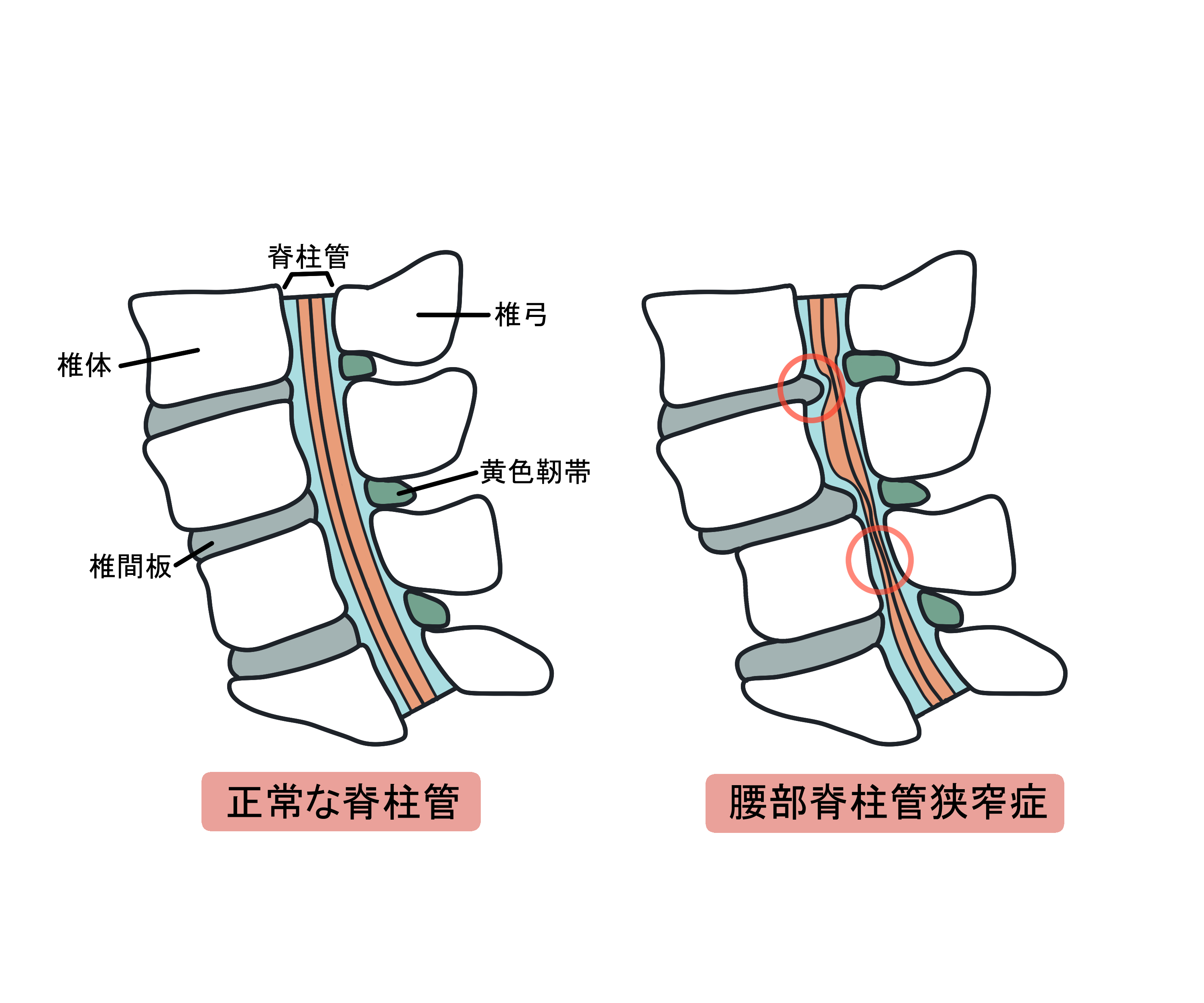 腰部脊柱管狭窄