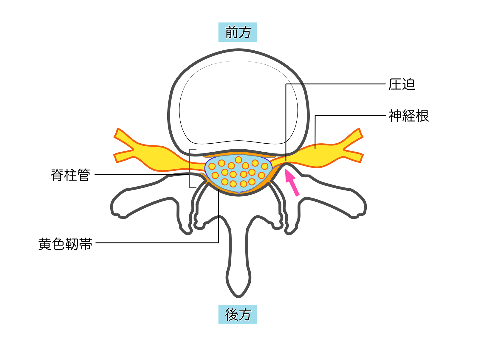 腰部脊柱管狭窄　神経根型