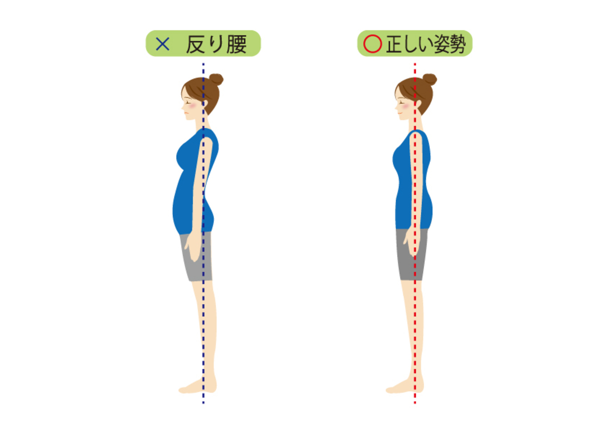 反り腰説明イラスト