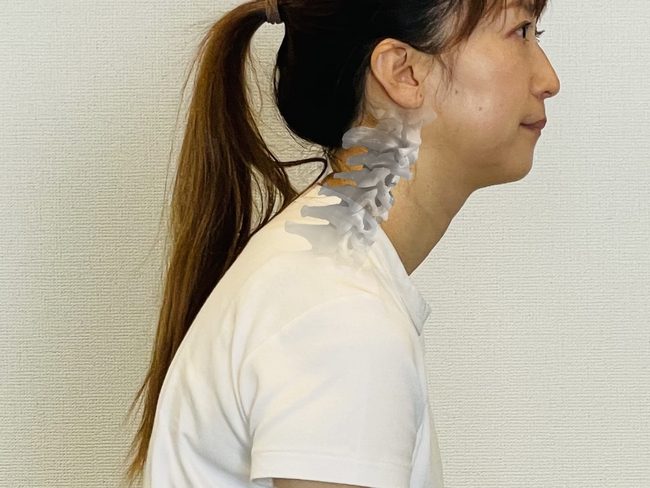 ストレートネックで頭が前に出た姿勢と首の骨の位置を重ねて示した日本人女性の横向き写真