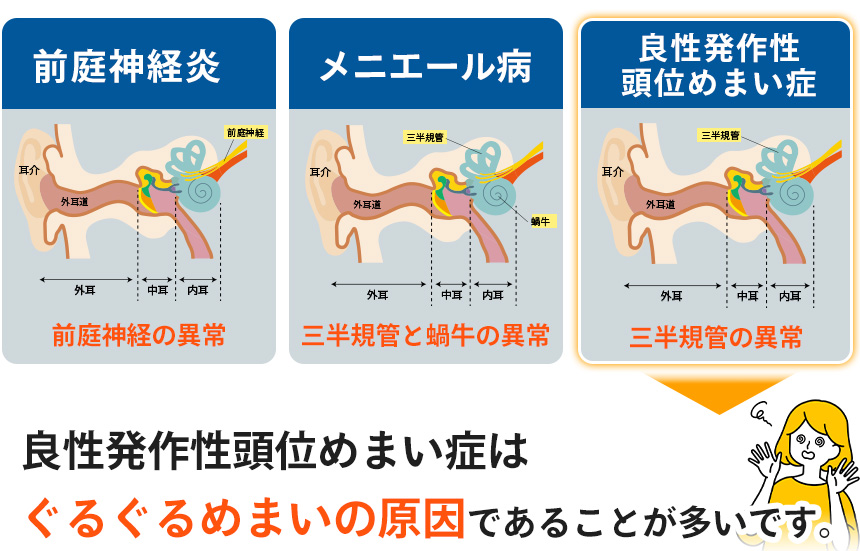 ぐるぐるめまいの原因