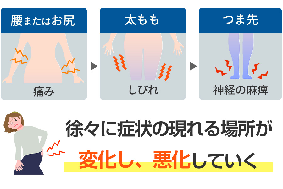 坐骨神経痛の症状の現れ方イメージ